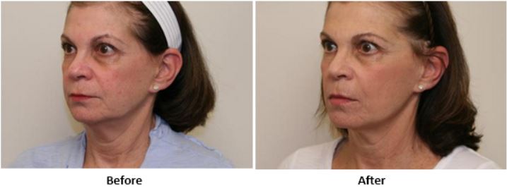 Woman's face before and after FotoFacial