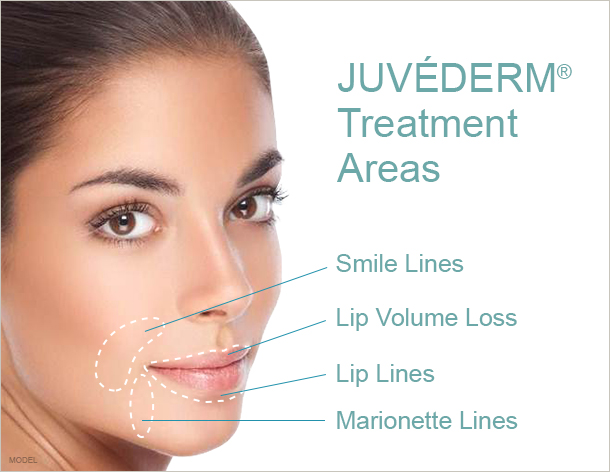 Juvederm treatment areas