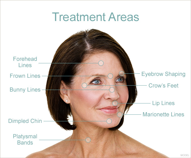 botox treatment areas on woman's face
