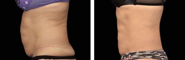 woman's stomach before and after emsculpt