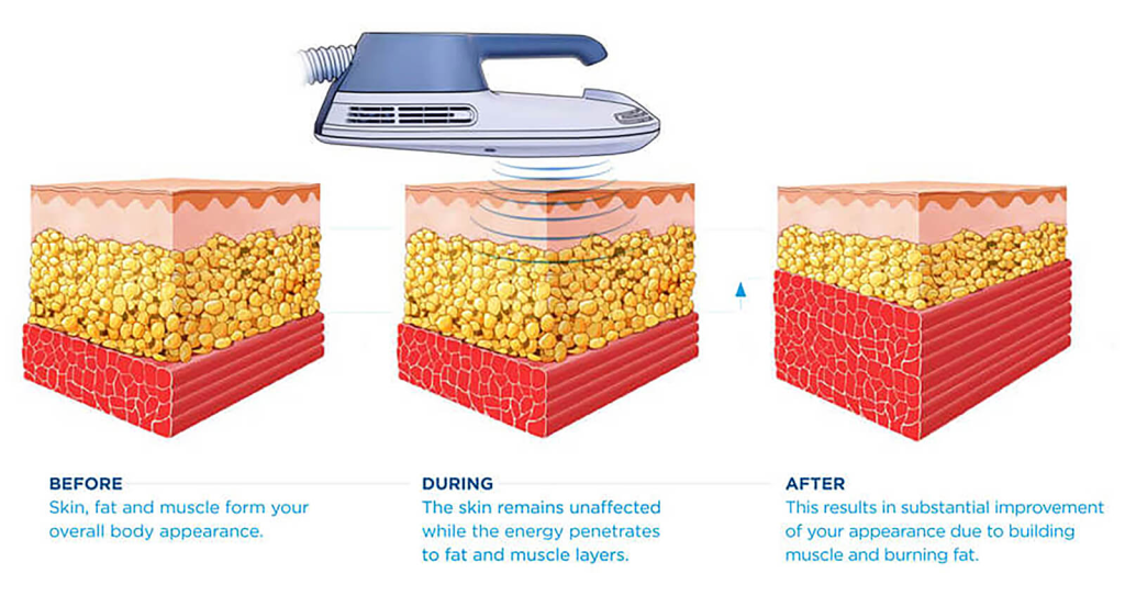 EMSCULPT Process, Before, During And After