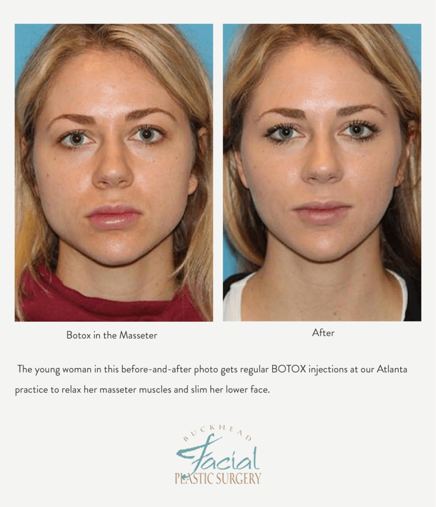 young woman before and after masseter reduction