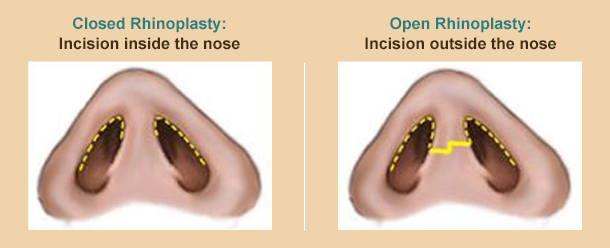 closed and open rhinoplasty graphic