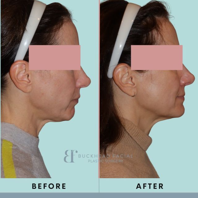 Celebrating this patient’s 3 months post-Sofwave!✨ Witness the radiant results of this innovative treatment as our patient's skin continues to glow with youthful vibrance. 💫 

Sofwave utilizes cutting-edge technology to deliver precise, non-invasive ultrasound waves deep into the skin's layers, targeting fine lines, wrinkles, and sagging. 💆‍♀️✨ 

The result? Improved skin elasticity, reduced appearance of wrinkles, and a more youthful complexion - all without downtime! 💖 

Call 4042333937📲 to book an appointment!

#bfps #buckhead #sofwave #emface #sylfirm #daxxify #atlanta #atlmedspa #atlantamedspa #atlplasticsurgery #atlplasticsurgeon #atlantaplasticsurgery #atlantaplasticsurgeon #Sofwave #SkinRejuvenation #NonInvasive #SofwaveResults