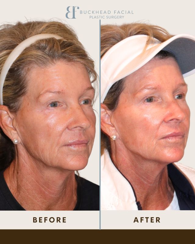 ✨ Restore, Lift & Glow with Sculptra! ✨

Looking for natural, long-lasting volume? Sculptra is the secret to restoring lost collagen and enhancing facial structure gradually and beautifully. 💉✨

🔥 Results by Dr. Jarmuz 🔥
✔️ Added volume to the cheeks & temples
✔️ Restored youthful contours
✔️ Stimulated collagen for long-term results

Subtle, natural, and stunning—book your Sculptra consultation today!

-

☎️ Call us at 404 233 3937.

-

-

-

#atlanta #atlmedspa #atlantamedspa #atlplasticsurgery #atlplasticsurgeon #atlantaplasticsurgery #atlantaplasticsurgeon