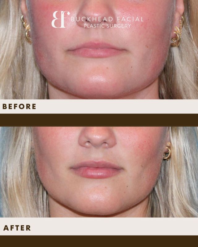 💋 Subtle. Smooth. Stunning.

Check out this lower face transformation! ✨ Johanna, our amazing Nurse Practitioner, used just 0.5 syringe of RHA 3 to enhance the lips while keeping things soft, balanced, and natural. 👄

Small touch, big difference 💫

-

☎️ Call us at 404 233 3937.

-
-
-
#atlanta #atlmedspa #atlantamedspa #atlplasticsurgery #atlplasticsurgeon #atlantaplasticsurgery #atlantaplasticsurgeon